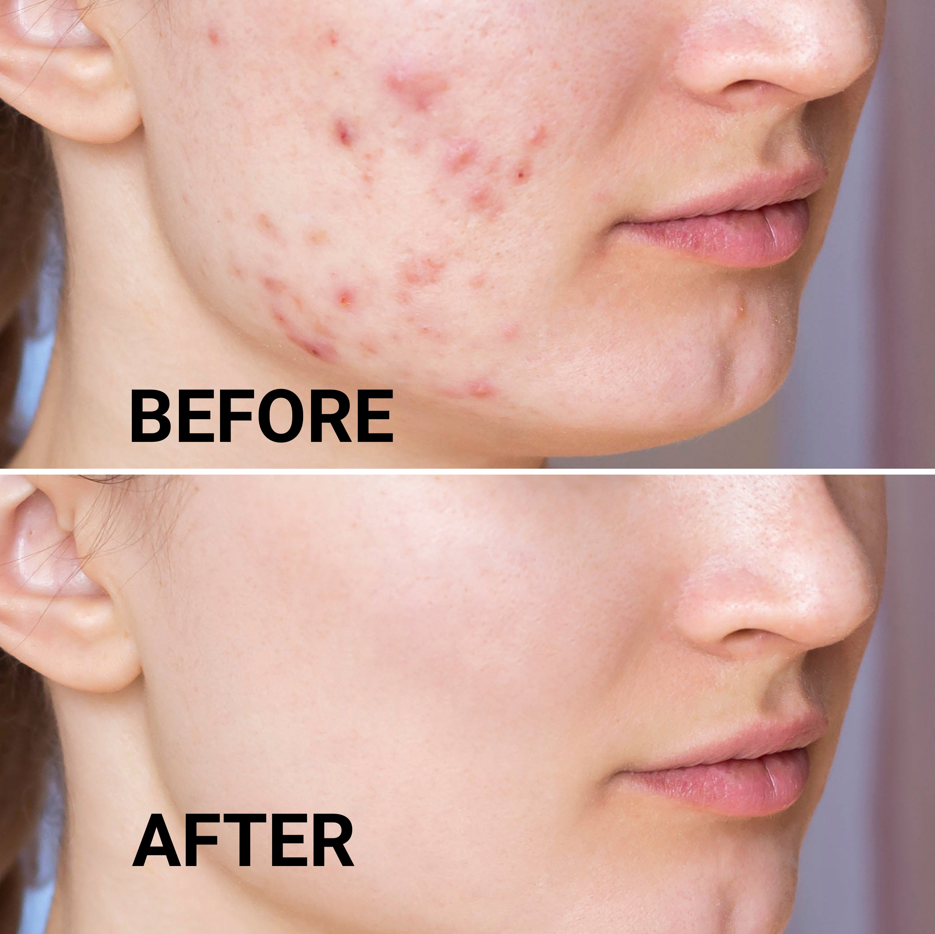 Acnecare Moisturizer (OTC)